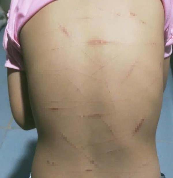 Vụ học sinh lớp 5 ở Cà Mau nghi bị bạo hành: Công an báo cáo vụ việc ban đầu như thế nào?