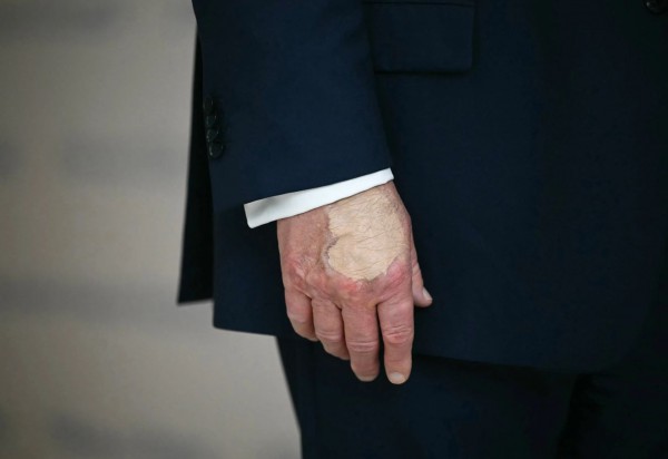 Dấu vết lạ trên mu bàn tay của Tổng thống Trump Dấu vết lạ trên mu bàn tay của Tổng thống Trump