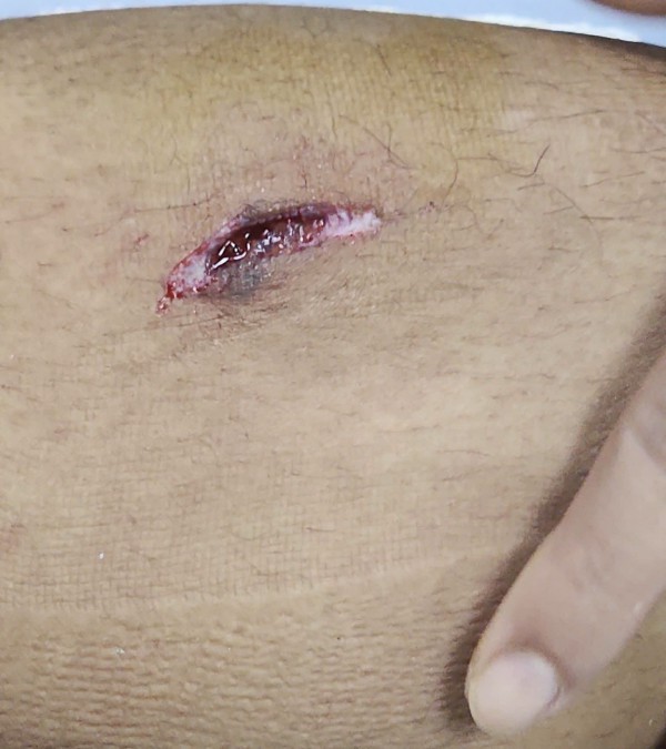 Trần Thành Trung chỉ bị khâu 5 mũi, vẫn kịp đá SEA Games 33: Thầy Kim thót tim Trần Thành Trung chỉ bị khâu 5 mũi, vẫn kịp đá SEA Games 33: Thầy Kim thót tim