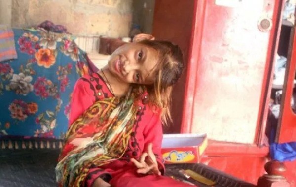 Bị té ngã hồi 8 tuổi, bé gái mắc hội chứng kỳ lạ ở cổ làm đầu nghiêng 90 độ, chờ đợi 2 năm vẫn chưa được phẫu thuật Bị té ngã hồi 8 tuổi, bé gái mắc hội chứng kỳ lạ ở cổ làm đầu nghiêng 90 độ, chờ đợi 2 năm vẫn chưa được phẫu thuật