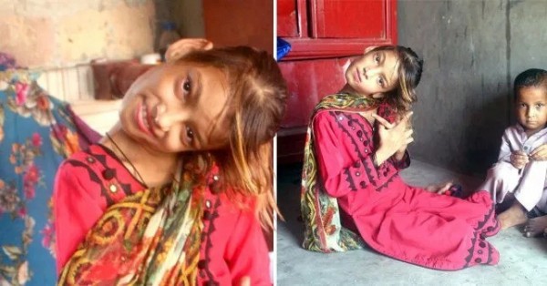 Bị té ngã hồi 8 tuổi, bé gái mắc hội chứng kỳ lạ ở cổ làm đầu nghiêng 90 độ, chờ đợi 2 năm vẫn chưa được phẫu thuật Bị té ngã hồi 8 tuổi, bé gái mắc hội chứng kỳ lạ ở cổ làm đầu nghiêng 90 độ, chờ đợi 2 năm vẫn chưa được phẫu thuật