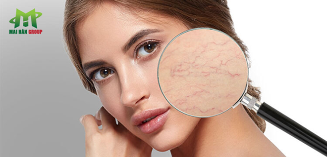 Công nghệ trị giãn mao mạch hiện đại cùng máy 980 nm Diode Laser Công nghệ trị giãn mao mạch hiện đại cùng máy 980 nm Diode Laser