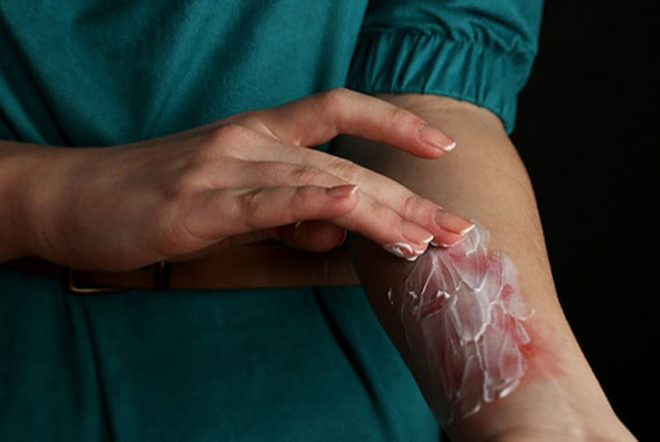 Làm thế nào xóa sạch sẹo bỏng lâu năm ngay tại nhà? Làm thế nào xóa sạch sẹo bỏng lâu năm ngay tại nhà?