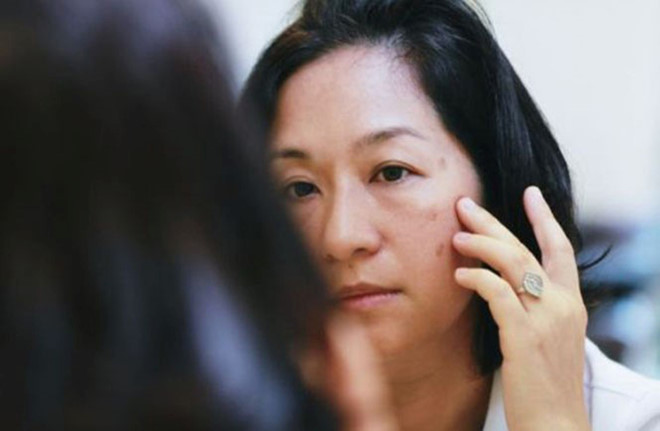 Tìm hiểu giai đoạn hình thành nám da và cách điều trị hiệu quả