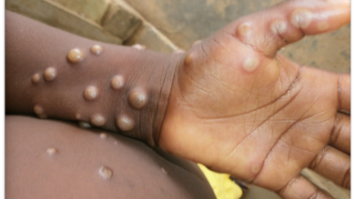 Bộ Y tế khuyến cáo các biện pháp phòng chống bệnh đậu mùa khỉ