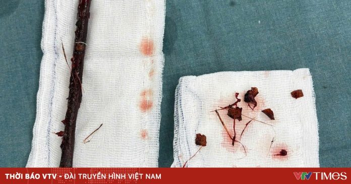 Bé gái 3 tuổi mang cành cây 16cm trong bụng 4 tháng