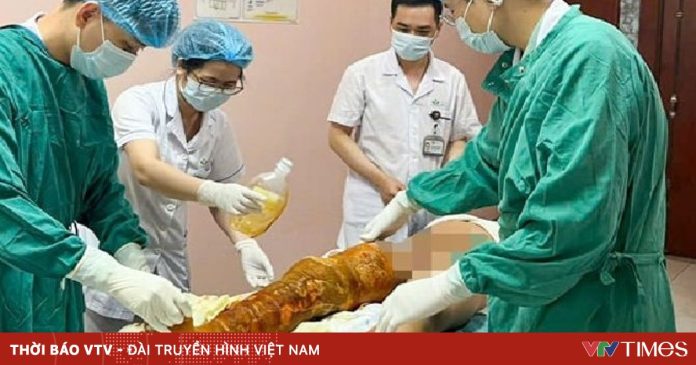 Bé trai bỏng nặng do tự làm thí nghiệm với cồn tại nhà