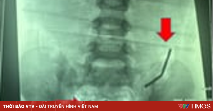 Bé trai thủng ruột 8 lỗ sau khi nuốt 20 viên nam châm