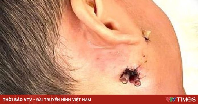 Bệnh nhi 4 tuổi thoát chết vì vi khuẩn “ăn thịt người” Bệnh nhi 4 tuổi thoát chết vì vi khuẩn “ăn thịt người”