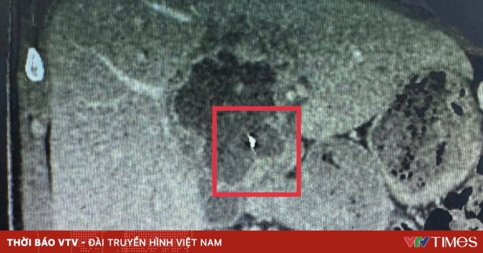 Ca bệnh hiếm gặp: Nội soi lấy dị vật kim loại trong gan