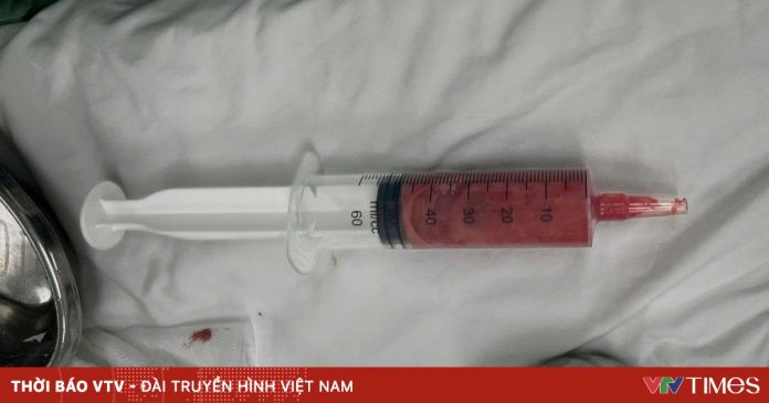 Cảnh báo biến chứng nặng sau khi tiêm chất làm đầy không rõ nguồn gốc