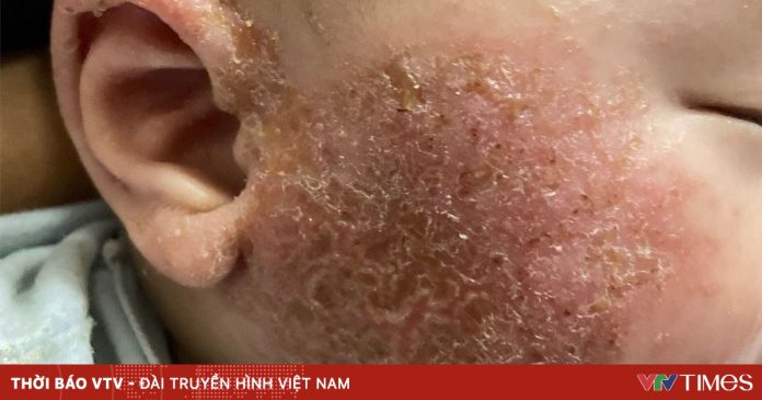 Cảnh báo các bệnh da liễu thường gặp khi thời tiết lạnh