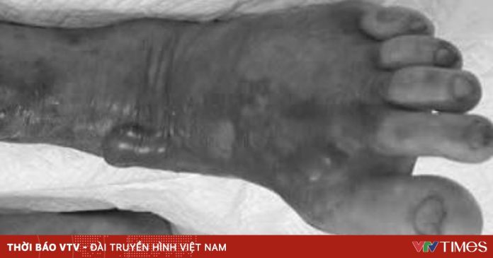 Cảnh báo nguy cơ nhiễm vi khuẩn “ăn thịt người” từ nước biển và hải sản sống