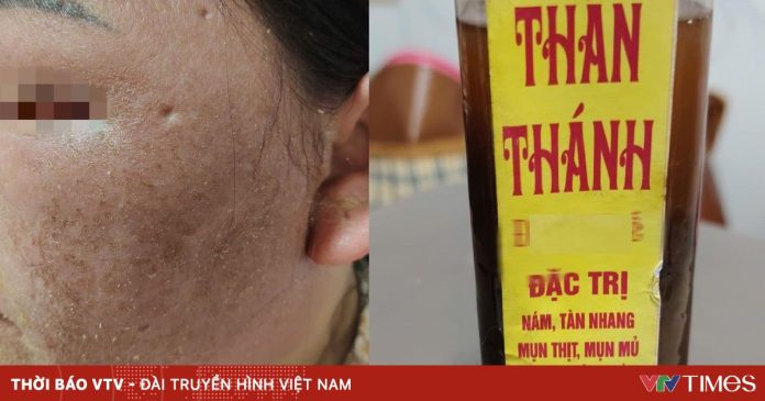 Cảnh báo nguy cơ tổn thương da do dùng “thuốc bôi thần thánh” trôi nổi Cảnh báo nguy cơ tổn thương da do dùng “thuốc bôi thần thánh” trôi nổi