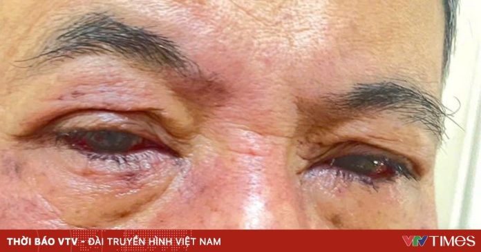 Cảnh báo tổn thương mắt do dị ứng thuốc