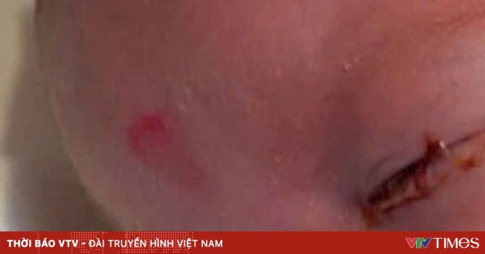 Cảnh báo viêm kết mạc ở trẻ sơ sinh Cảnh báo viêm kết mạc ở trẻ sơ sinh