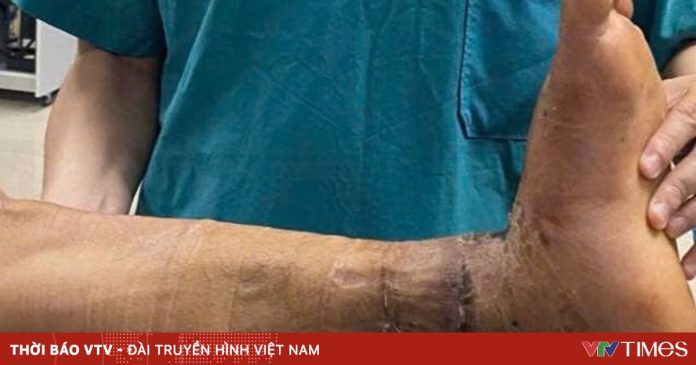 “Chạy đua với thời gian” cứu bàn chân bị đứt rời “Chạy đua với thời gian” cứu bàn chân bị đứt rời