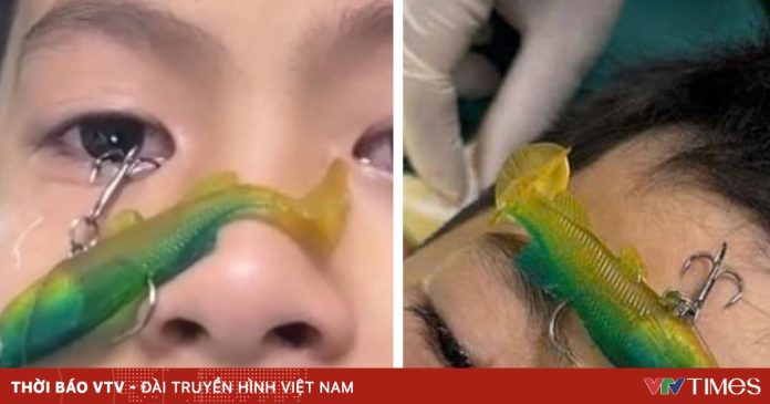 Cứu bé trai bị móc câu cá đâm xuyên nhãn cầu