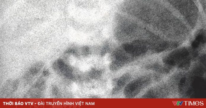 Cứu sống bé trai sinh non 36 tuần bị teo ruột non và thoát vị cuống rốn