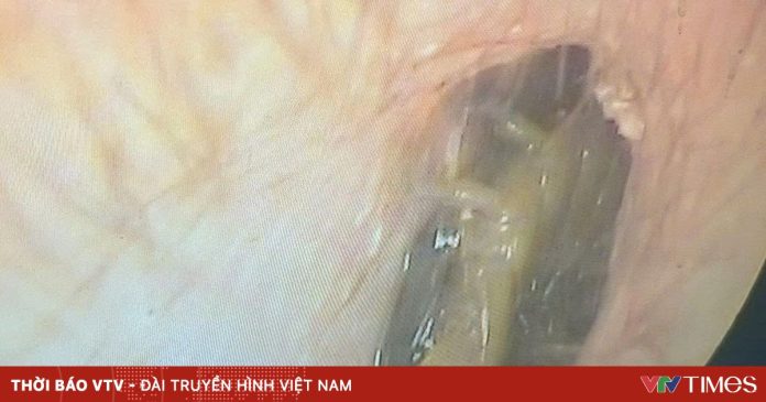 Hy hữu: Gắp thành công con rết còn sống trong ống tai người đàn ông Hy hữu: Gắp thành công con rết còn sống trong ống tai người đàn ông