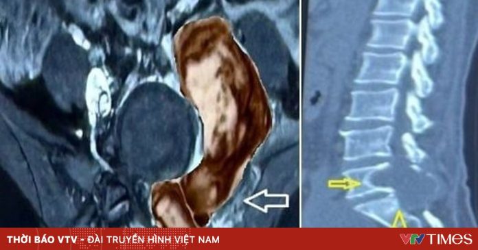 Khối u quái ác quay lại sau thời gian dài “ngủ yên”