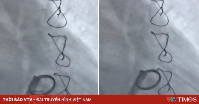 Kịp thời tiêu sợi huyết cứu bệnh nhân bị huyết khối kẹt van tim nhân tạo Kịp thời tiêu sợi huyết cứu bệnh nhân bị huyết khối kẹt van tim nhân tạo