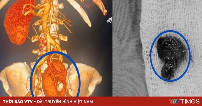 Lấy sỏi thận cho một trường hợp thận lạc chỗ hiếm gặp