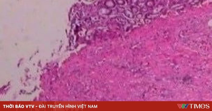 Nấm – kẻ giấu mặt nguy hiểm trong cơ thể người bệnh Nấm – kẻ giấu mặt nguy hiểm trong cơ thể người bệnh