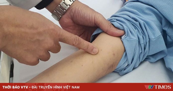 Nam thanh niên 24 tuổi ở Hà Nội mắc bệnh não mô cầu Nam thanh niên 24 tuổi ở Hà Nội mắc bệnh não mô cầu