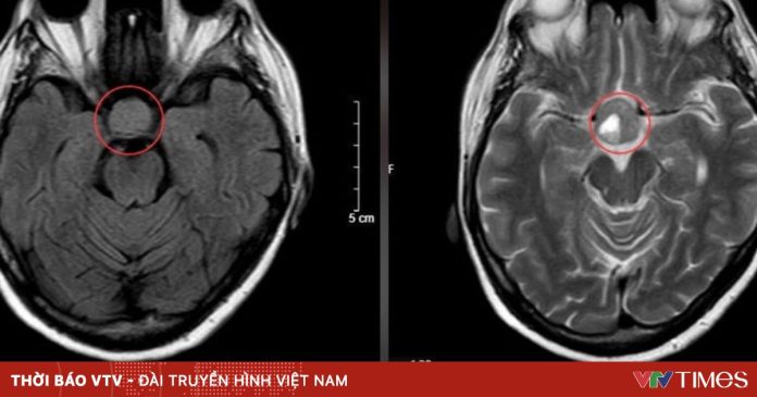 Nhìn mờ kéo dài, phát hiện u tuyến yên nguy hiểm