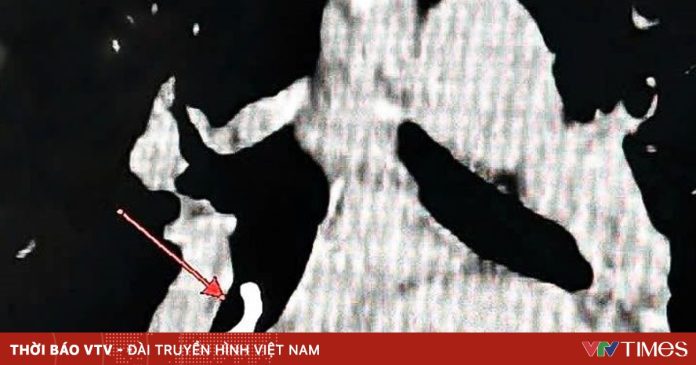 Phát hiện dị vật phế quản hiếm gặp sau hơn 1 tháng điều trị không hiệu quả Phát hiện dị vật phế quản hiếm gặp sau hơn 1 tháng điều trị không hiệu quả