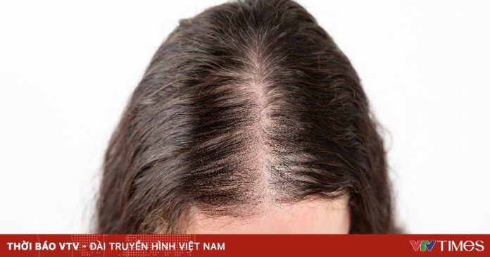 Phát hiện tình cờ loại đường giúp đảo ngược rụng tóc di truyền mà không cần thuốc Phát hiện tình cờ loại đường giúp đảo ngược rụng tóc di truyền mà không cần thuốc