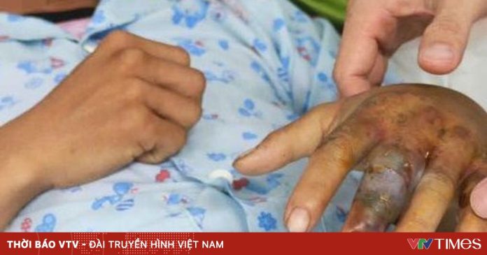 Rắn cắn nguy hiểm: Không đắp lá, không chữa mẹo