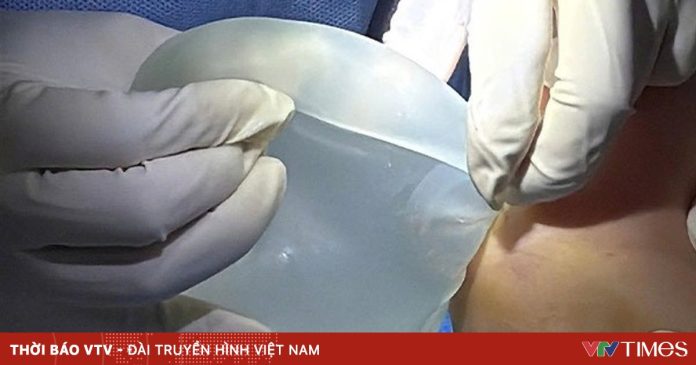 Tháo túi ngực cho phụ nữ có bệnh lý nền Tháo túi ngực cho phụ nữ có bệnh lý nền