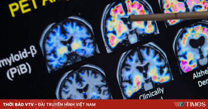 Thiếu hụt một nguyên tố quen thuộc có thể làm tăng nguy cơ Alzheimer Thiếu hụt một nguyên tố quen thuộc có thể làm tăng nguy cơ Alzheimer