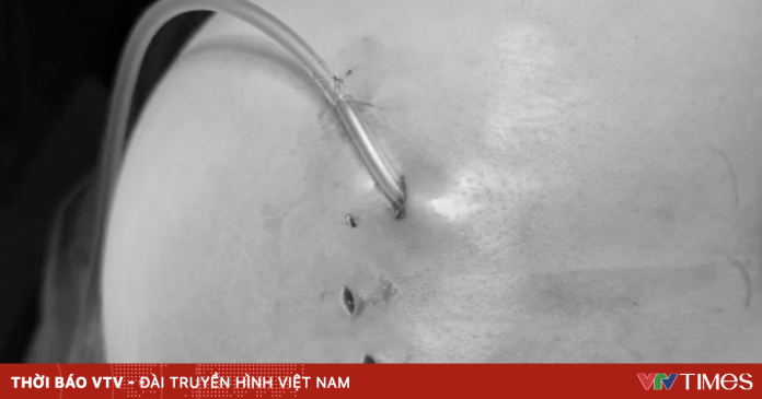 Tiêm filler: Làm đẹp nhanh hay cái giá sức khỏe phải trả?