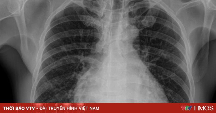 Tổn thương phổi – nguyên nhân hàng đầu gây tử vong liên quan truyền máu Tổn thương phổi – nguyên nhân hàng đầu gây tử vong liên quan truyền máu