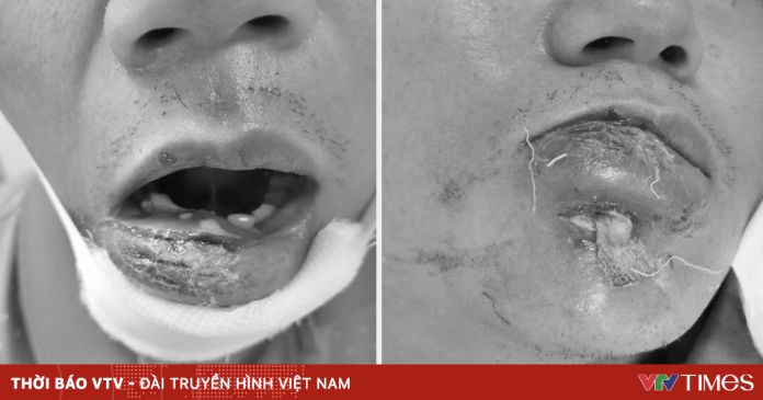 Tự điều trị mụn, nam bệnh nhân nhập viện vì nhiễm vi khuẩn đa kháng thuốc