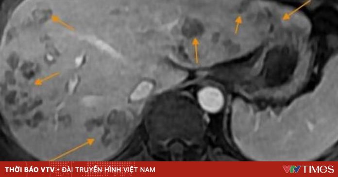 Ăn đồ sống, người đàn ông 41 tuổi ở Hà Nội bị sán lá gan gây tổn thương nặng