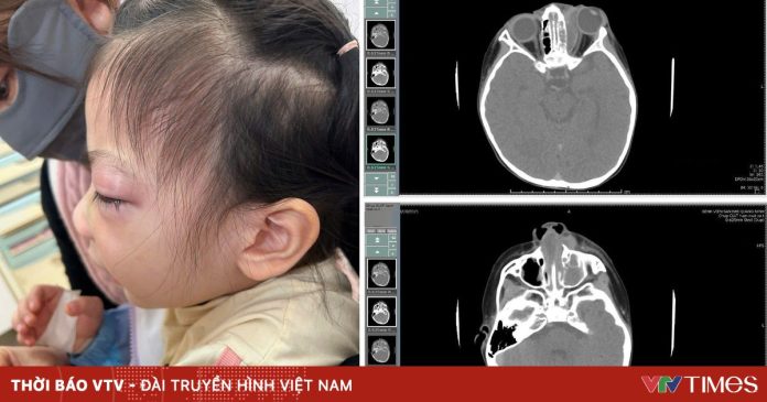 Áp xe ổ mắt do viêm xoang kháng kháng sinh