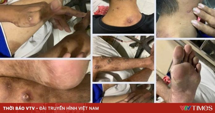 Đồng Nai ghi nhận ca bệnh đậu mùa khỉ chưa rõ nguồn lây